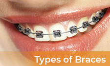 Types of Braces with Text